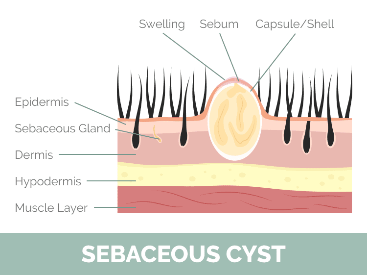 Sebaceous Cyst