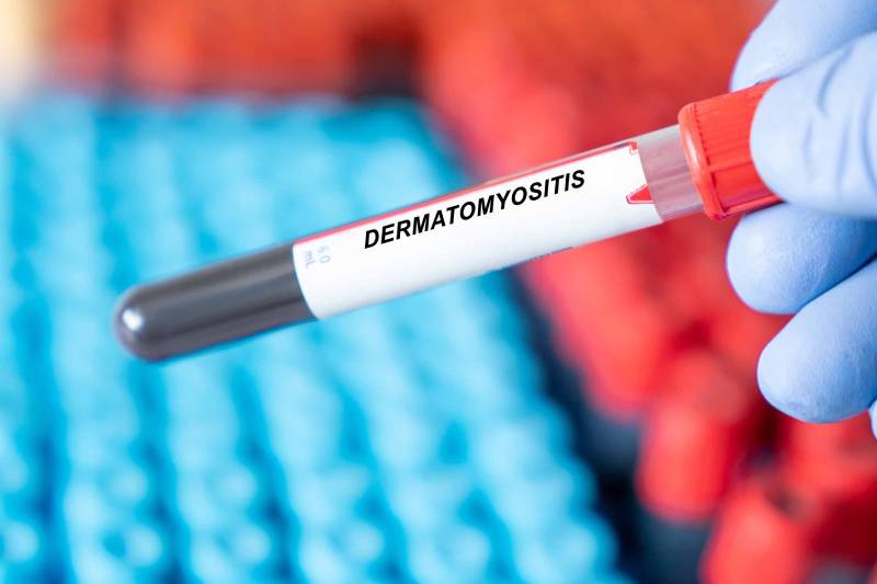 Dermatomyositis disease blood test inmedical laboratory