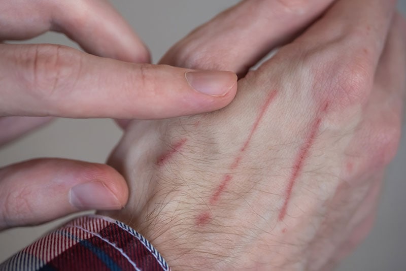 man showing hand with cat scratches on skin